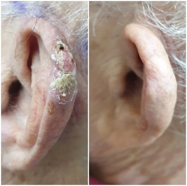 Squamous Cell Carcinoma of the Ear