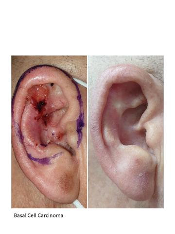 Basal cell carcinoma