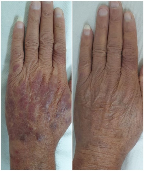 Kaposi sarcoma