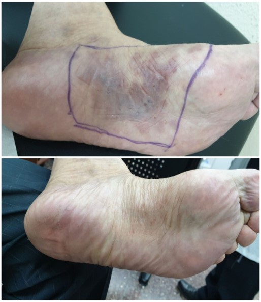 Kaposi sarcoma