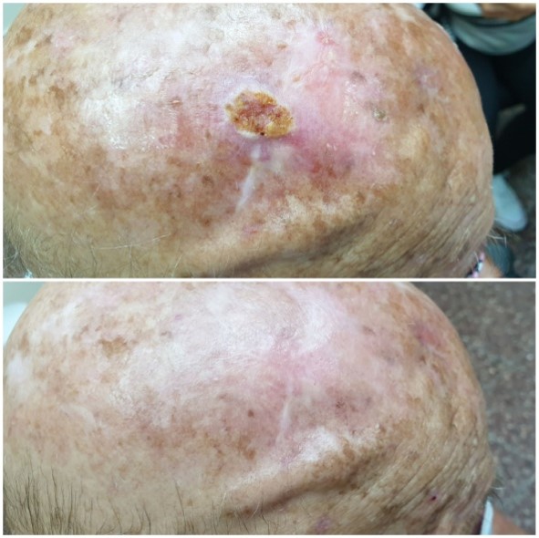 Reccurent SCC in a Surgical Scar
