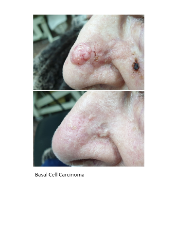 Basal Cell Carcinoma